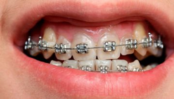 Cómo saber si necesito brakets o frenos | Odontotecks