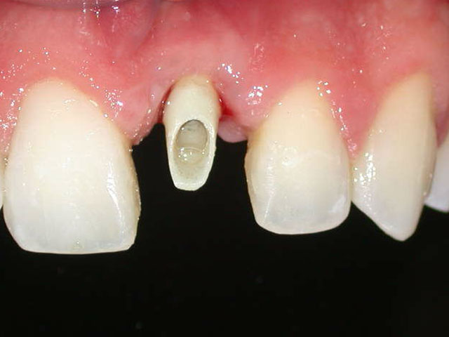 Implante-dental-antes