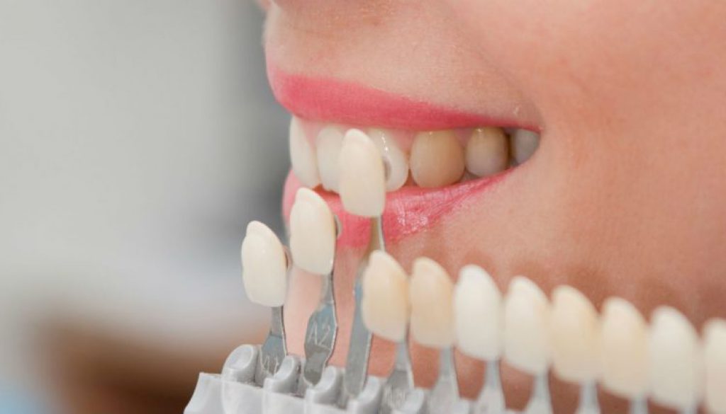Carillas dentales, todo lo que necesitas saber