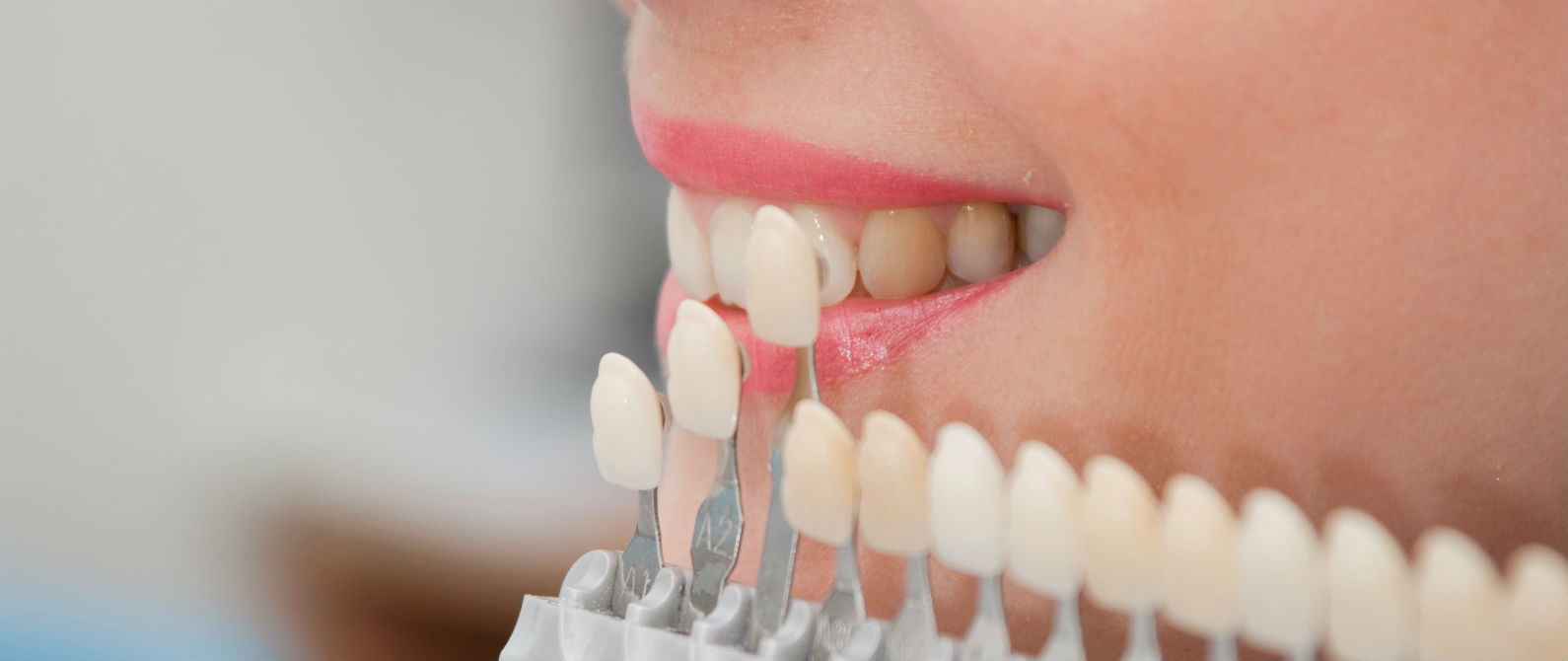 Carillas dentales, todo lo que necesitas saber