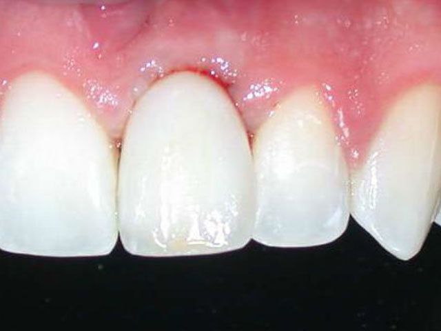 implante-dental-despues