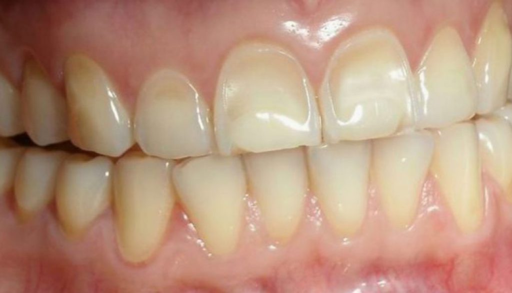 Erosión dental y lo que lo ocasiona