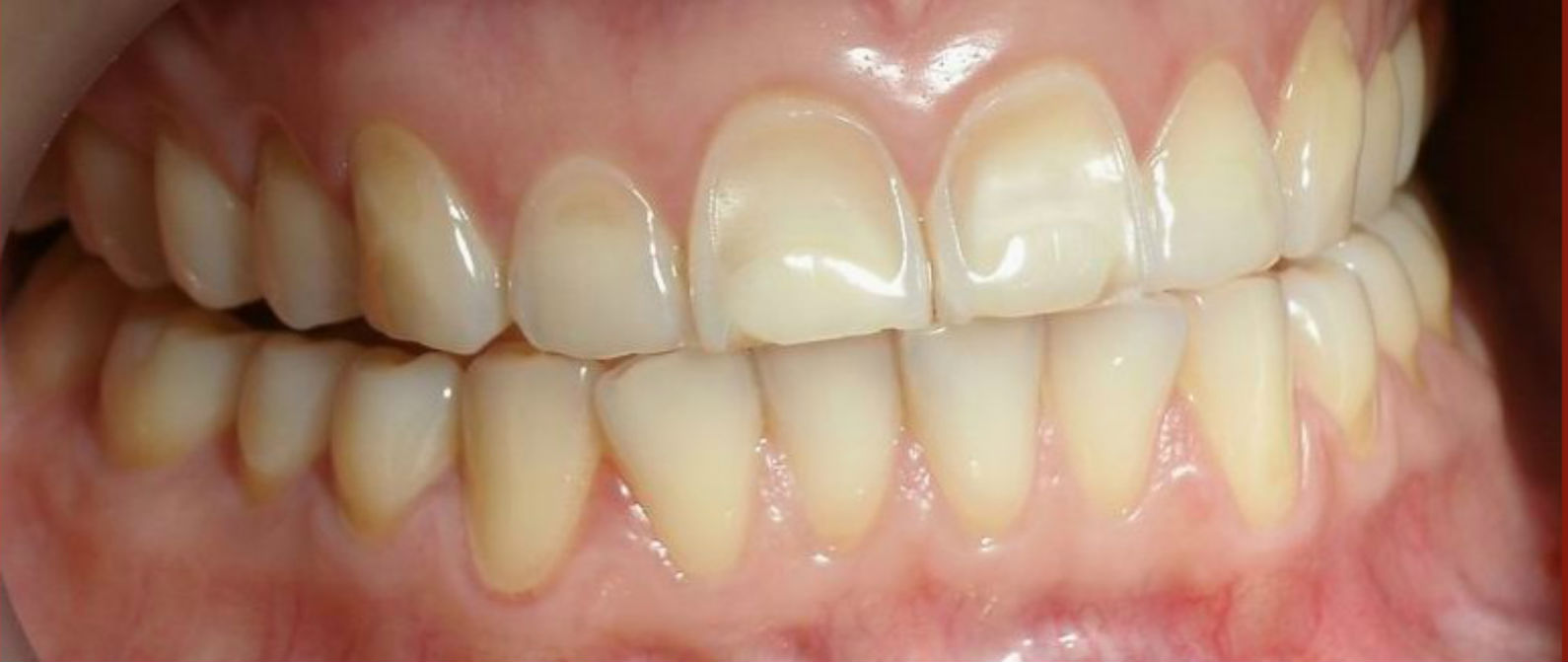 Erosión dental y lo que lo ocasiona