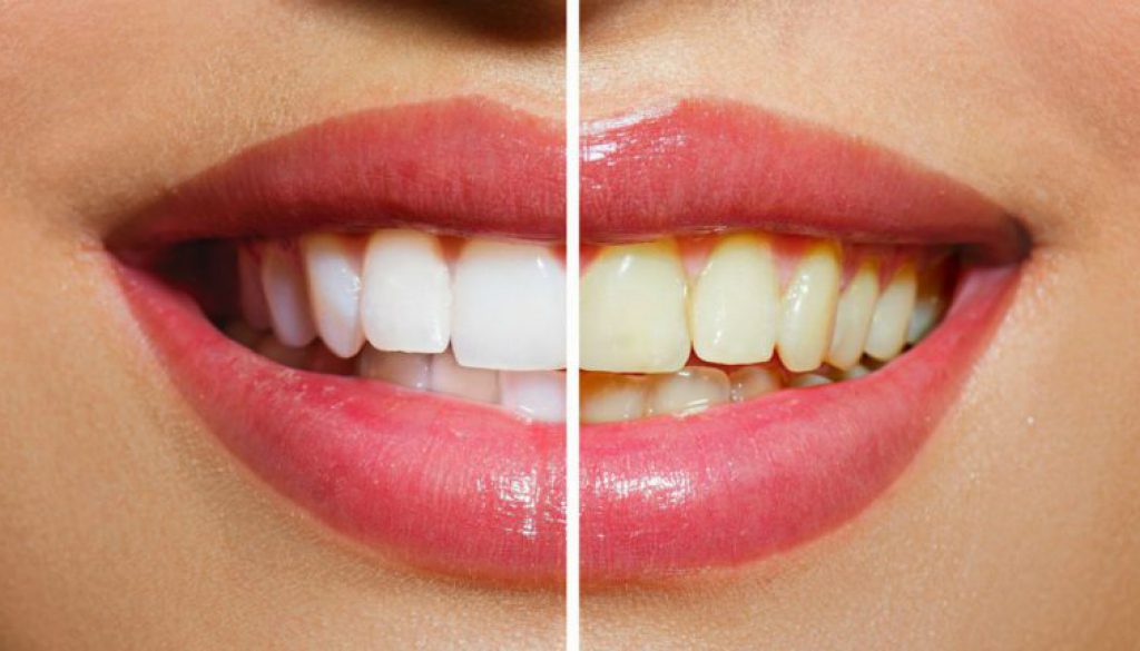 Mitos del blanqueamiento de dientes