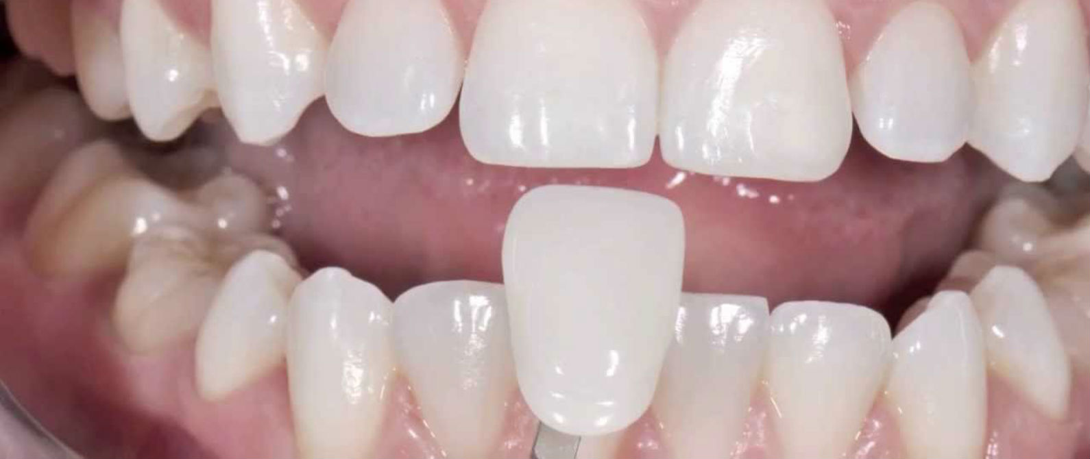 Qué son las carillas dentales