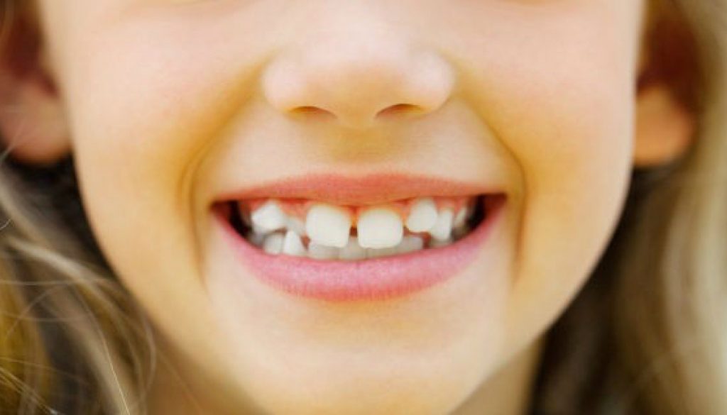 dientestorcidossobrepuestosbrackets Odontotecks