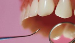 ventajas-de-las-resinas-dentales