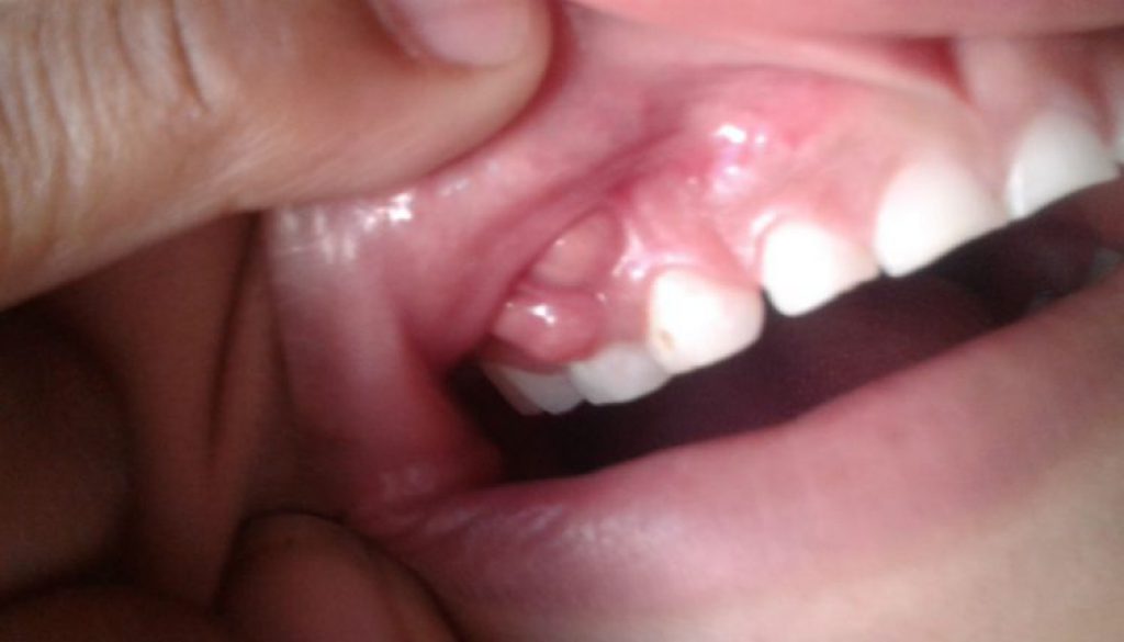 Identifica un absceso dental
