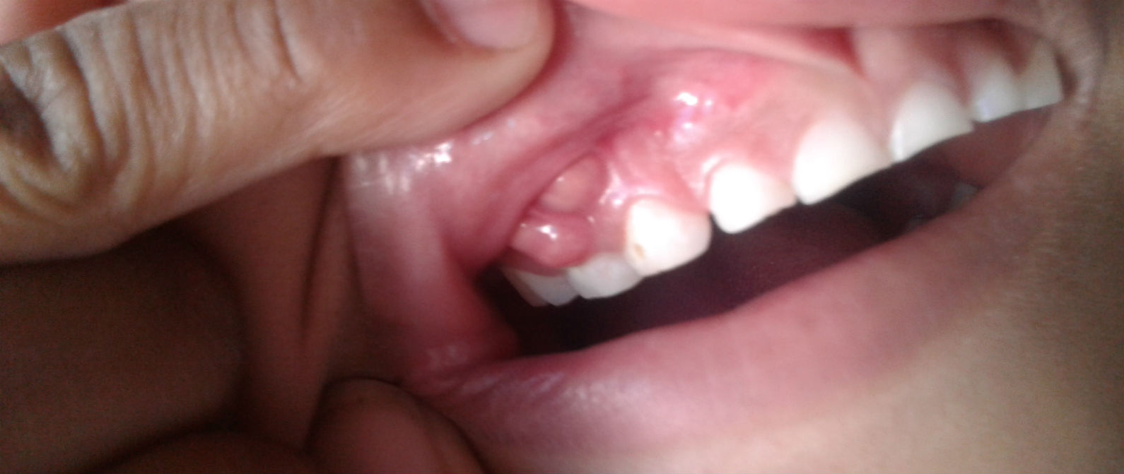 Identifica un absceso dental