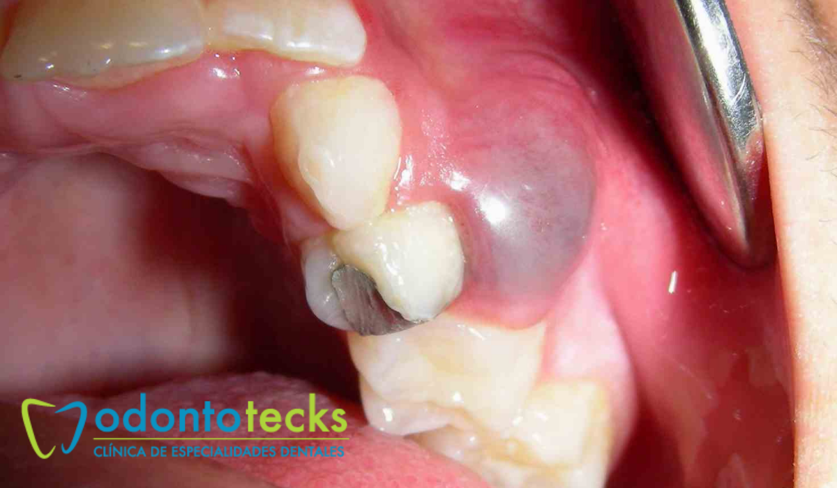 Quistes Dentales Causas Y Tratamiento Odontotecks 7058