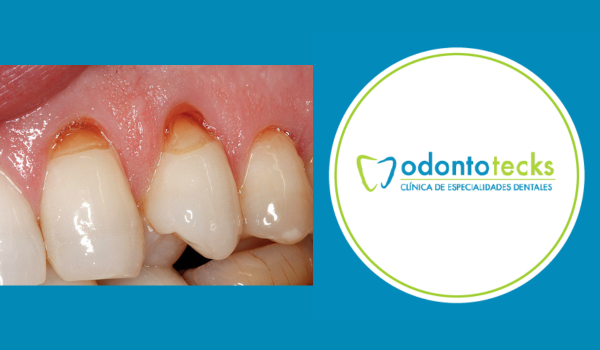 abfraccion dental – Odontotecks