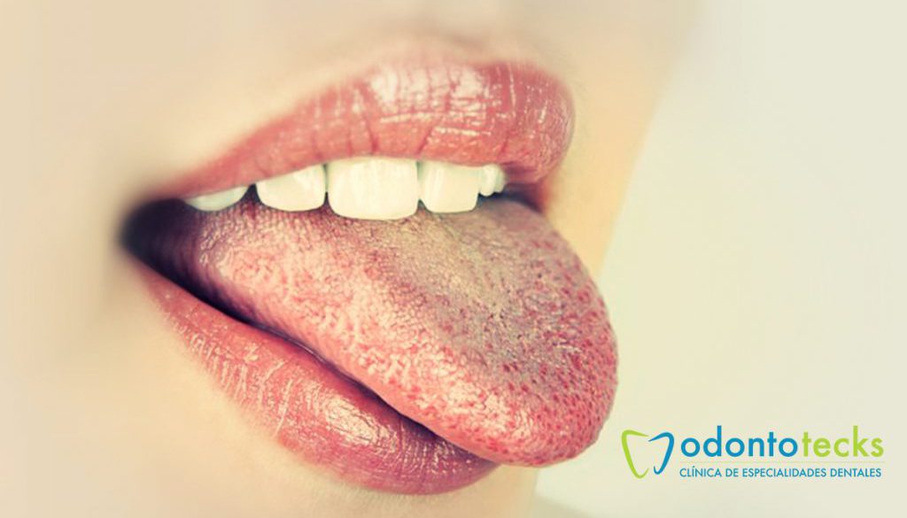 lengua-blanca-causas-y-tratamientos2