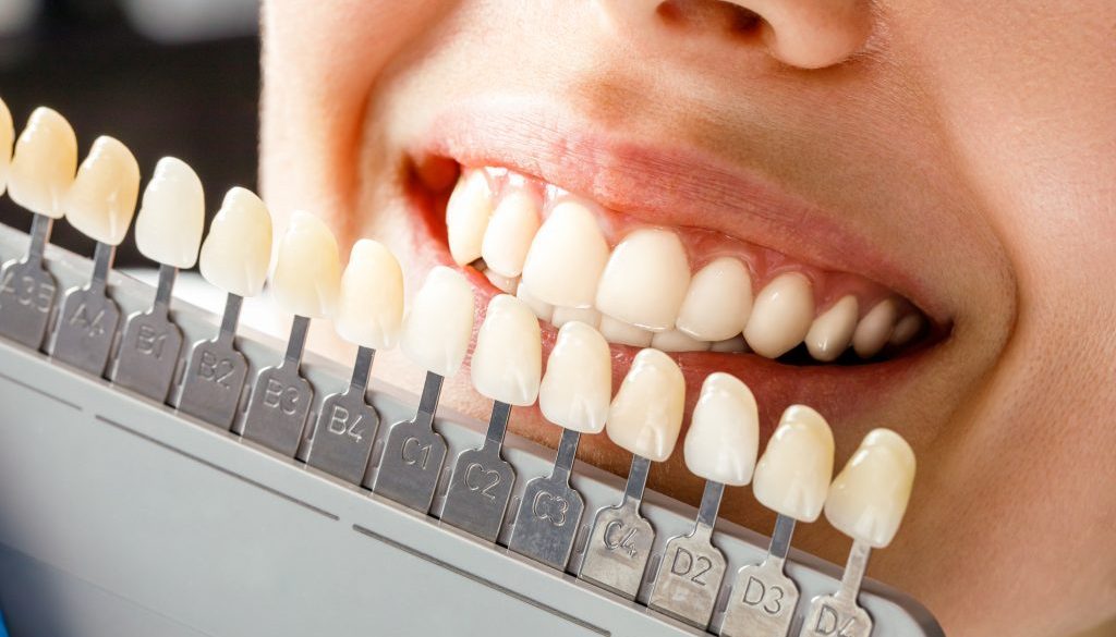 Smiling,Young,Woman.,Cosmetological,Teeth,Whitening,In,A,Dental,Clinic.
