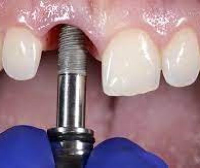 implantes_dentales